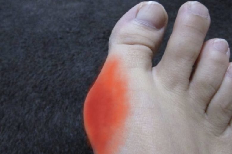 外反母趾、親指の付け根の痛み
