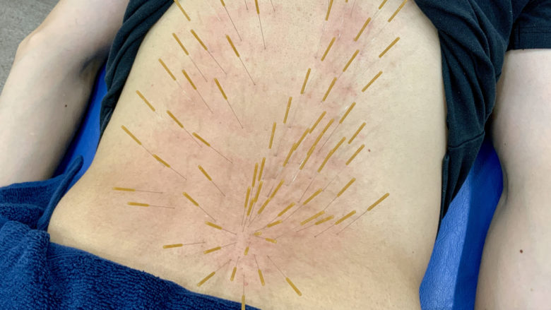 ドライニードリングの利点は何ですか?